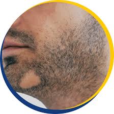 Traumatic alopecias cause hair to. Facial Hair Beard Loss The Knudsen Clinic