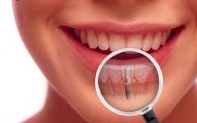 What is the cheapest dental implant? How Much Do Dental Implants Cost Soho Dental A Downtown Toronto Dentist