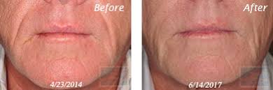 Here are 11 tips from realself community members that you may find helpful. Juvederm Voluma New Orleans Dermal Fillers Wrinkles On Face