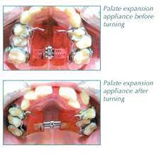 Before And After Expansion Bozemansmiles Bozemanmontana Orthodontics Orthodontics Orthodontist Assistant Dental Assistant