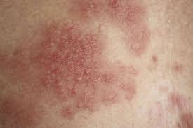 Image result for itchy skin rectum