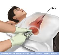 A biopsy is a sample of tissue taken from the body in order to examine it more closely. Great Lakes Gastroenterology Liver Biopsy