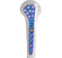 Invictus MIS Modular,Medical Device & Implants Manufacturer ...