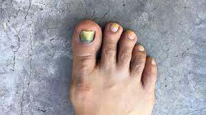 The big toe shows redness and swelling of an ingrown toenail is a common disorder that most often affects the outer edges of the nail of the big toe (hallux) most frequently. Toenail Disorders During Chemotherapy Prevention And Care