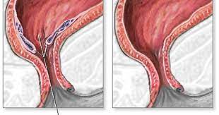 4 signs your hemorrhoid needs medical attention hemorrhoids cure for hemorrhoids home remedies for hemorrhoids