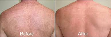 This service can be performed on just about anyone, and on most body parts. Laser Hair Removal In Chevy Chase Md Washington Dc The West Institute