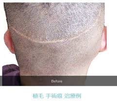 「"新しいコメントをメールで通知" depigmentation」の画像検索結果