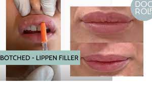 Er meinte es sei ein lipom und ich hätte das wohl schon immer. Verpfuschte Lippe Knubbel Und Knoten Entfernen Behandlung Mit Hylase Dr Rolf Bartsch Youtube