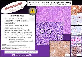 Angioimmunoblastic t cell lymphoma (aitl) is a peripheral t cell lymphoma characterized by systemic disease, a polymorphous infiltrate involving lymph nodes, and a prominent proliferation of. Socforhemepath Auf Twitter Did You Know Adult T Cell Leukemia Lymphoma Atll May Be Indistinguishable From Other T Cell Lymphomas Here Is A Case Of Atll Mimicking Angioimmunoblastic T Cell Lymphoma Aitl With Hodgkin Like Cells Shtopics