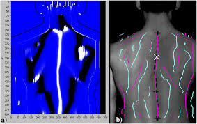 Areas of the human back. Determination Of The Human Spine Curve Based On Laser Triangulation Springerlink