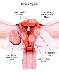 Myome Wie Gefahrlich Sind Sie Wirklich Netzwerk Frauengesundheit Ratgeber Fur Frauenheilkunde