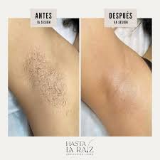 Dile adiós a los rastrillos 👋🏽💁🏻♀️ Sorpréndete con este antes y después  de 4 sesiones de nuestro tratamiento de depilación láser 👆🏼😱 Recuerda  que con nosotros, tu cita de valoración es totalmente