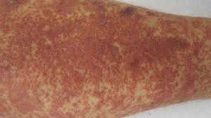 Batemans purpura is described as a weakening of the blood vessels and connective tissues, just below the skin surface. Purpura Causes Diagnosis Treatment And Pictures