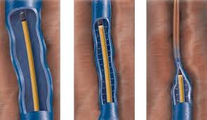 Image result for Radiofrequency Surgery