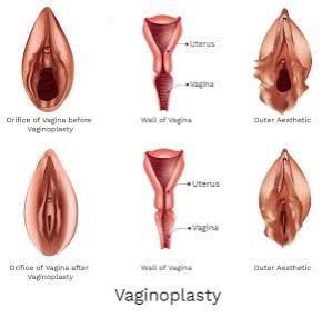 Operating on private parts: How private do you want to keep it? -  Medicosnext