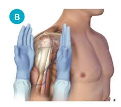 Image result for Intraosseous Access