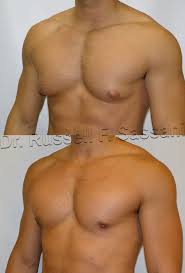 Liposuction Fort Lauderdale Fl Cosmetic Surgery Gynecomastia Surgery Plastic Surgeon Gynecomastia