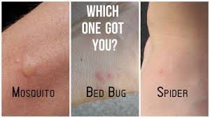 Bug Bites That Look Like Mosquito Bites But Hurt Pin On Garage Conversion