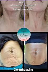 Everyone loves having a glass of wine or a cocktail. Get Rid Of Turkey Neck And Saggy Skin Saggy Skin Skin Tightening Stomach Skin Bumps