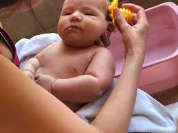 Image result for Cradle Cap