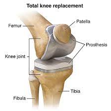 Total knee replacement surgery is a complex operation. Total Knee Replacement