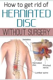 How To Get Rid Of Herniated Disc Without Surgery Justbeautytips Net Herniated Disc Herniated Herniated Disc Exercise
