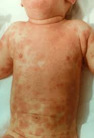 Racgp Kawasaki Disease The Importance Of Prompt Recognition And Early Referral