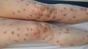 O altă posibilitate de transmitere a senzaţiei de prurit sunt neuronii nociceptivi tip a delta. Dermato Info Le Prurit Et Le Prurigo