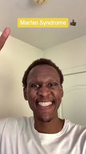 Marfan Syndrome 👍🏿 #ChachaReelSmooth #marfansyndrome #connective #tissue  #tall #awareness #michaelphelps #tems #fyp