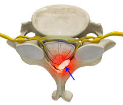 Image result for Spinal Epidural Abscess