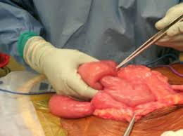Image result for Adult Intussusception