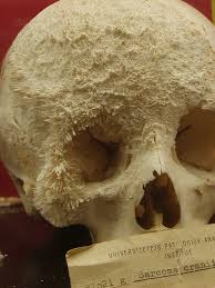 I have felt the pain of a broken bone. Skull Of A Person Who Had Bone Cancer Pics