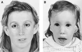 Le syndrome de franceschetti, ou maladie de treacher collins, est une maladie génétique qui entraîne des malformations au niveau du visage. Treacher Collins Syndrome Comprehensive Evaluation And Treatment Oral And Maxillofacial Surgery Clinics
