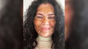 Angela's story: Vitiligo is part of my identity