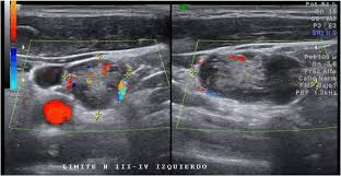 Our doctors also use ultrasound to check lymph nodes in the neck, where some forms of thyroid cancer can spread. Neck Ultrasound Lymph Nodes With Heterogenous Echotexture Mixed Download Scientific Diagram