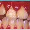 The most used antibiotics for tooth abscess are amoxicillin and clindamycin. Https Encrypted Tbn0 Gstatic Com Images Q Tbn And9gcttz5djpnkkcq6qwaew852qcpbwzhtsty0hfpjx4zh5bbexg0pn Usqp Cau