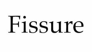 Learn more about the word palpebral fissure , its origin, alternative forms, and usage from wiktionary. How To Pronounce Fissure Youtube