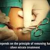 It presents acutely as an abscess under tension while the chronic form gives rise to intermittent discharge from pilonidal sinus(es). 1