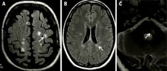 Multiple sclerosis (ms) is the most common inflammatory. Esclerosis Multiple Sciencedirect