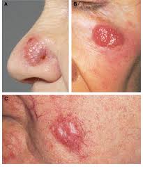 Image result for Merkel Cell Carcinoma