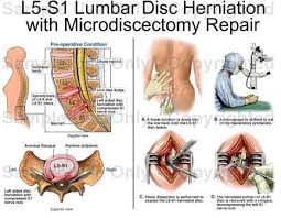Click To Enlarge In 2020 Disk Herniation Herniated Disc Lower Back Herniated Disc Exercise