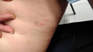 Como Identificar Y Curar Las Picaduras De Pulgas
