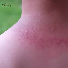 Image result for sweat rash on back