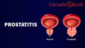 Image result for Chronic Bacterial Prostatitis