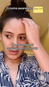 Scalp eczema is way more common than people realize. Millions deal with the  itching, flakes, and flare-ups every day. Nearly 1 in 25 people live with  scalp eczema. , If you’re in the Charlotte area, ...