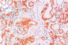 Congo red stain is the gold standard for the demonstration of amyloid in tissue sections. Renal Histology With Congo Red Staining Revealing Extensive Download Scientific Diagram