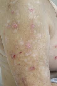 Pruritus In Chronic Kidney Disease Plastic Surgery Key
