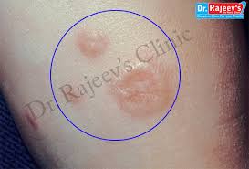 These bumps come and go then come again but more often. Homeopathy Treatment For Granuloma Annulare