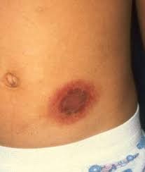 Image result for Fixed Drug Eruption