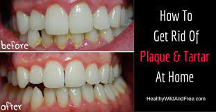 Can you get rid of tartar on teeth? How To Remove Tartar From Teeth Naturally At Home Teethwalls